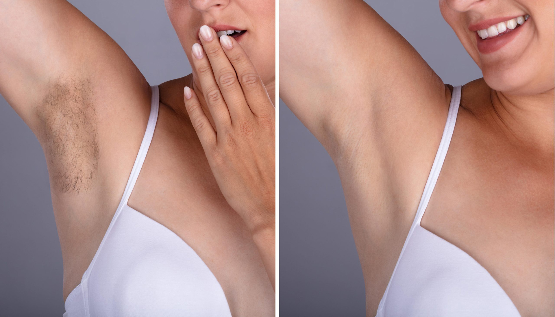 Side by side photos of a woman with her arm up, showing unshaved underarm on the left, hair removed on the right 