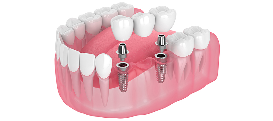 implant3