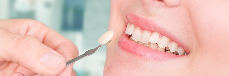 veneers1