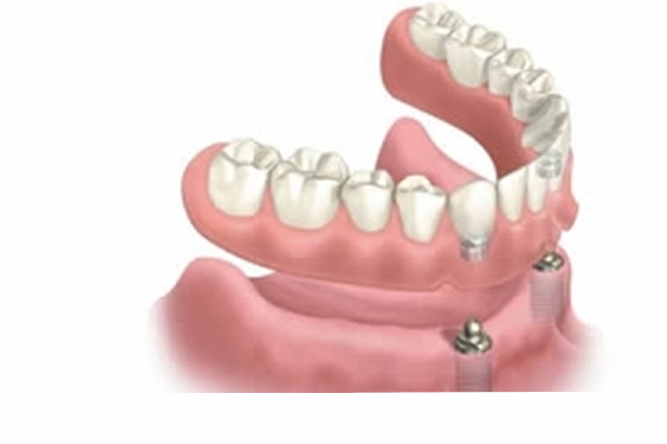 a model of full dentures custom fit