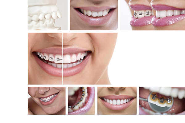 photos of before and after shots of braces