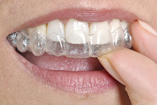 Lady using Invisalign in lieu of braces
