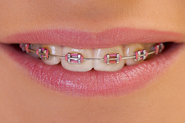 pink braces on all upper teeth