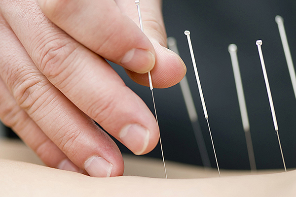 Acupuncture using a needling technique