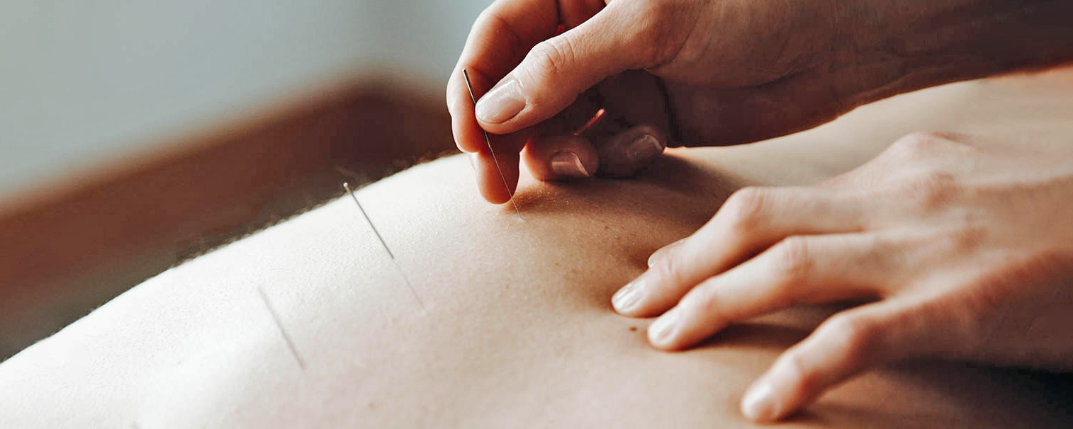 Hands inserting acupuncture needles into back. 